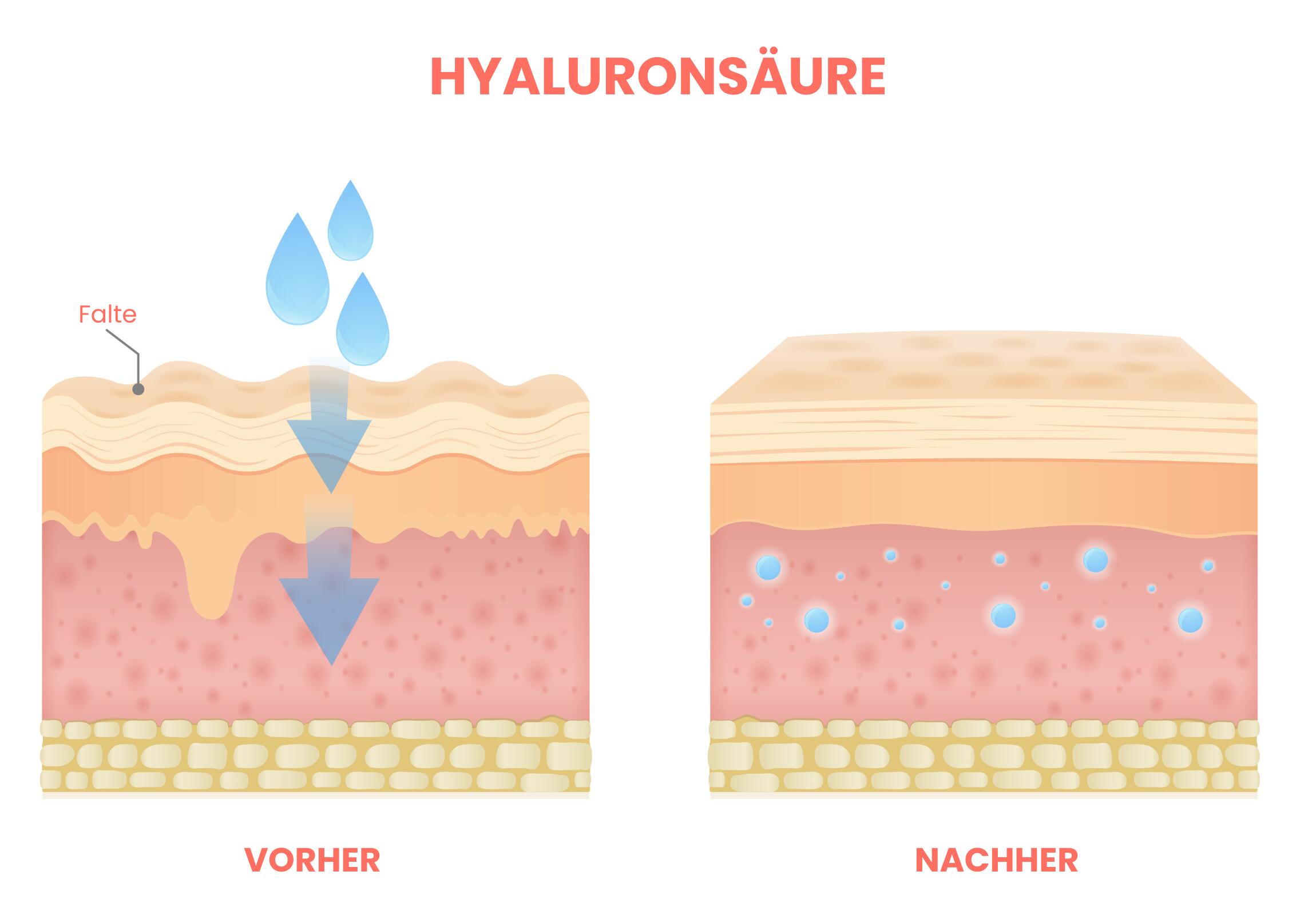 Illustration eines Hautquerschnitts, die zeigt, wie Hyaluronsäure Feuchtigkeit in die Haut einlagert und dadurch Falten glättet und die Haut praller erscheinen lässt.